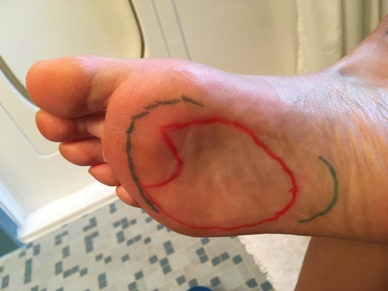 Capsulitis and Foot Pain • Fibromyalgia Athlete